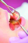 implantitis